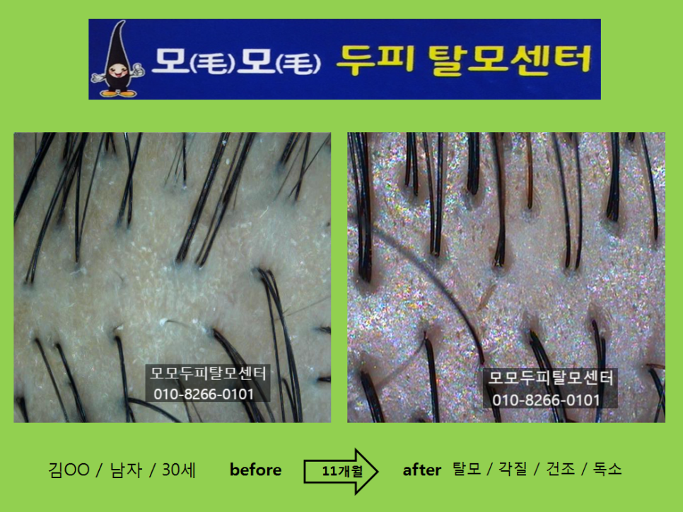 모모두피탈모센터 photo 5