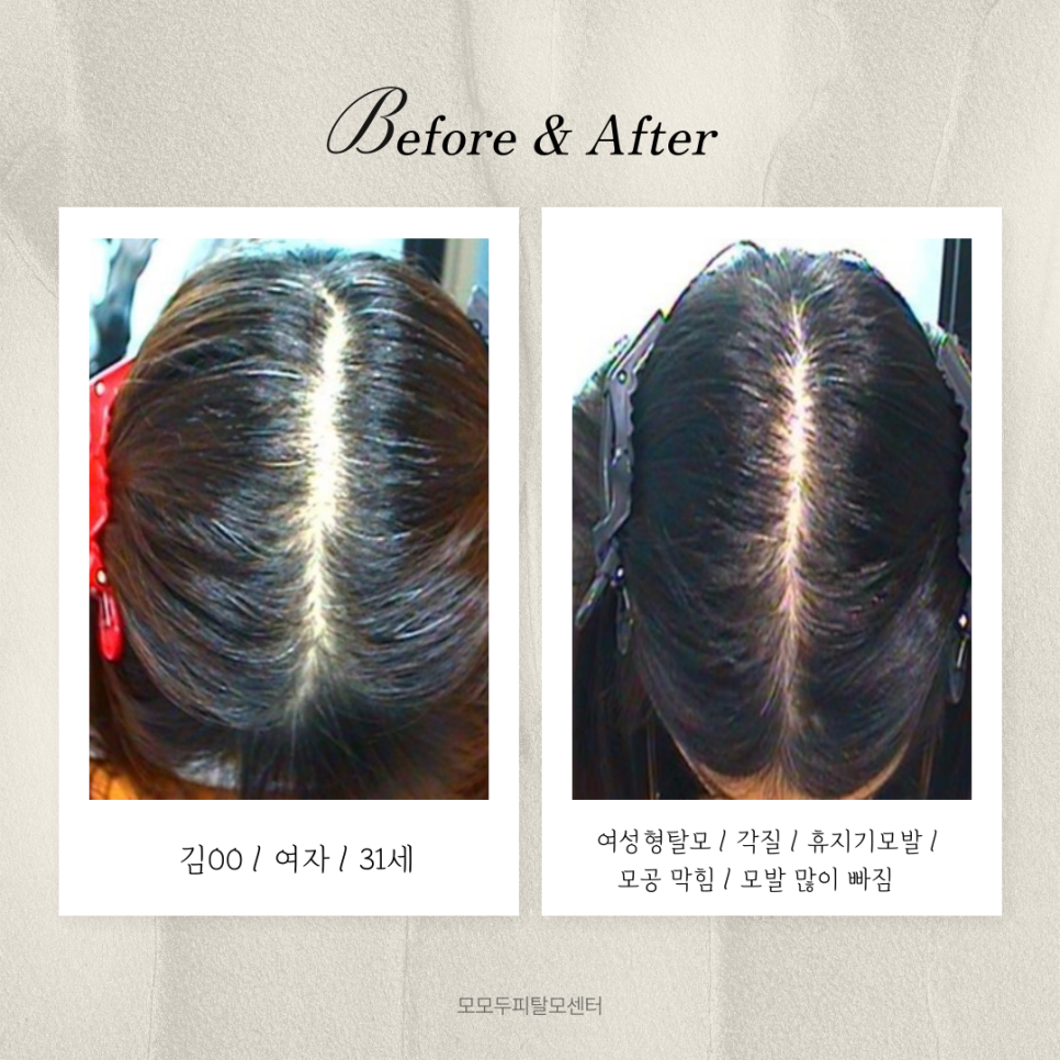 모모두피탈모센터 photo 9