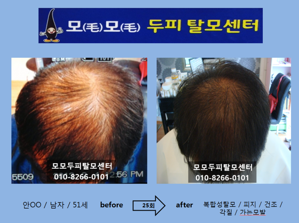 모모두피탈모센터 photo 2